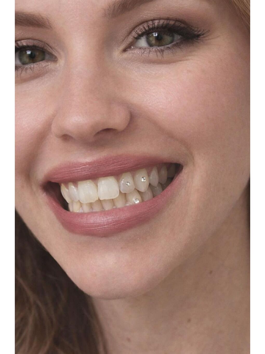 Zirkon Yapıştırma Diş Taşı