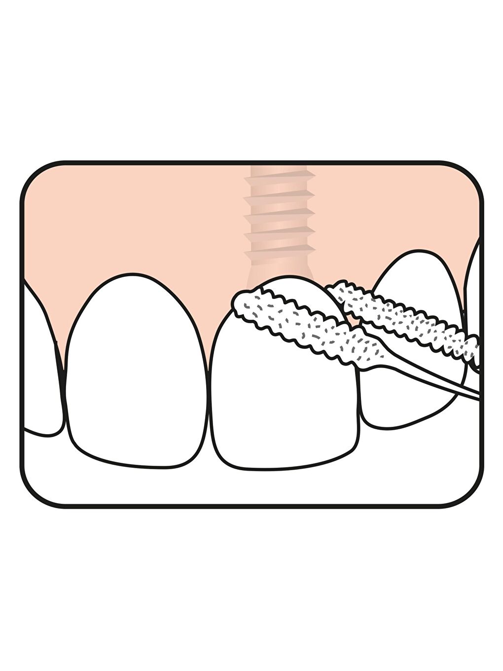 Tepe Renksiz İmplant Floss Diş İpi - 2