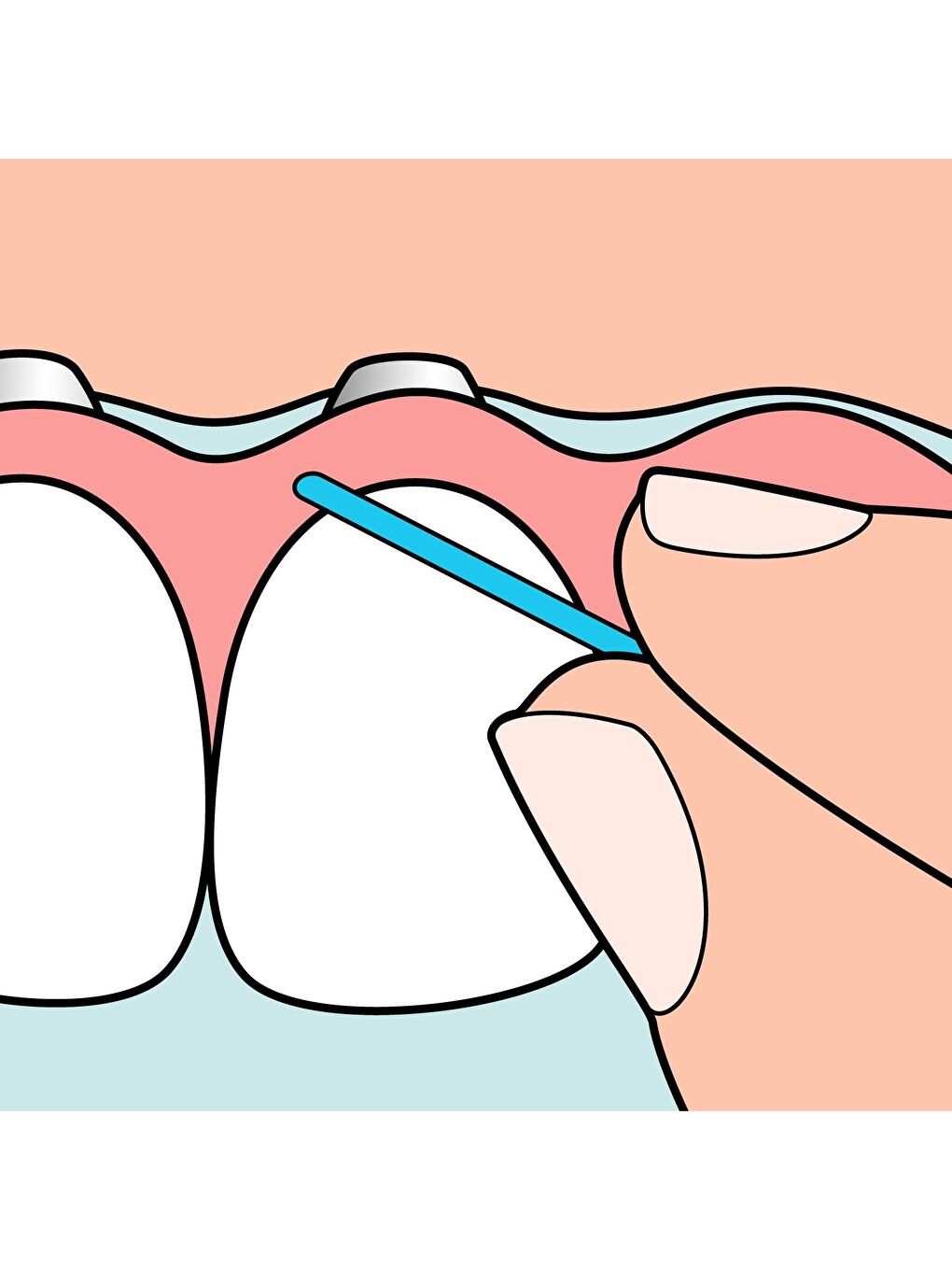 Tepe Renksiz İmplant Floss Diş İpi - 4